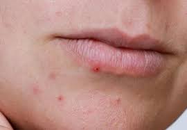 Understanding Lip Pimples: Causes, Prevention, and Treatment